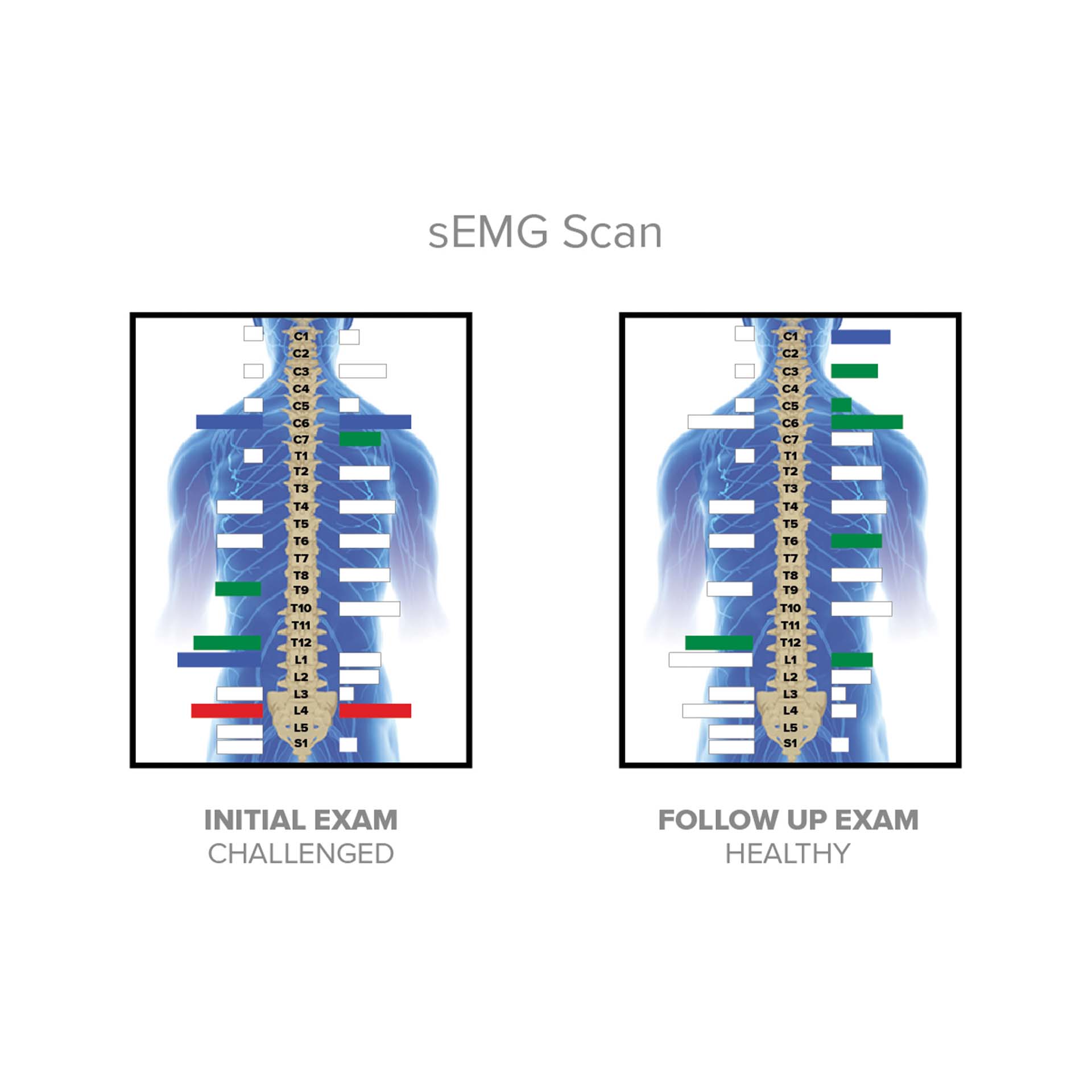 INSiGHT neuroCORE (sEMG)